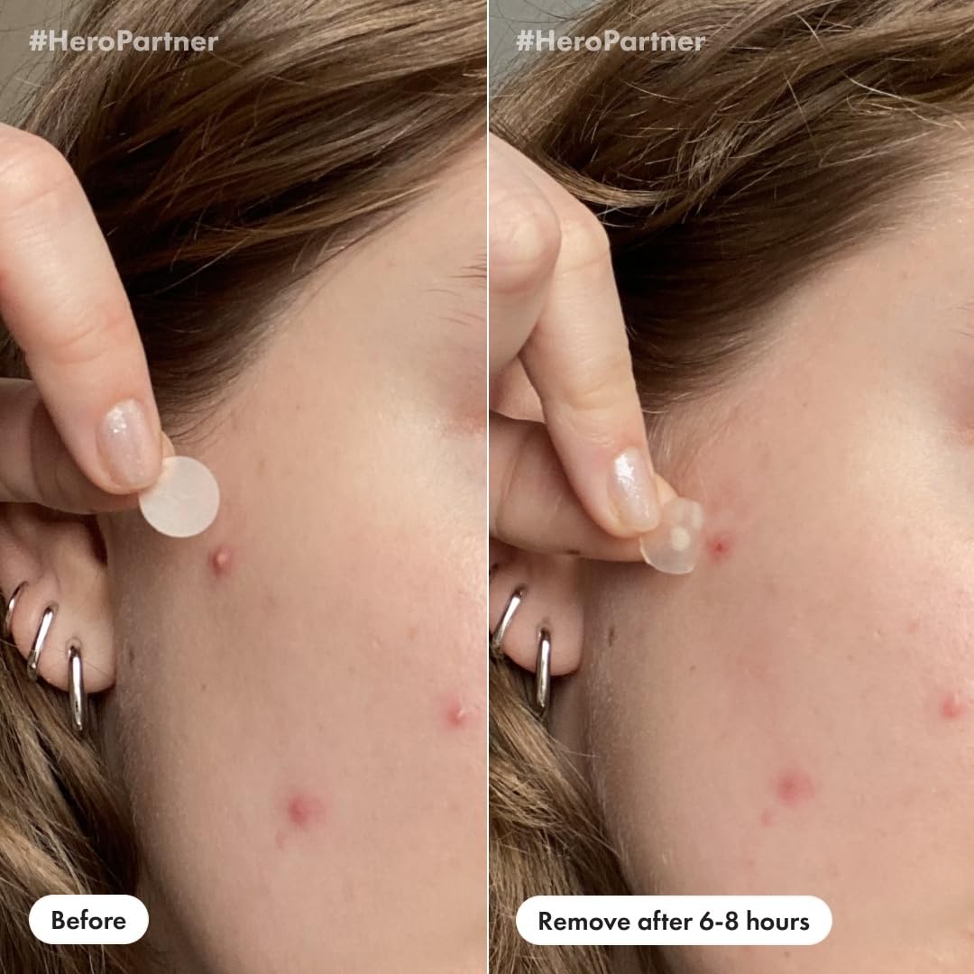 Mighty Patch Original Pimple Patches